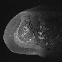 Liposarcoma MRI 2